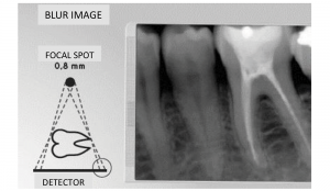 Instalatie retroalveolara RXDC - punct focal - imagine blur