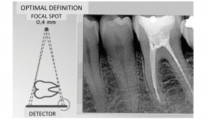 Instalatie retroalveolara RXDC - punct focal - imagine otpimal definition