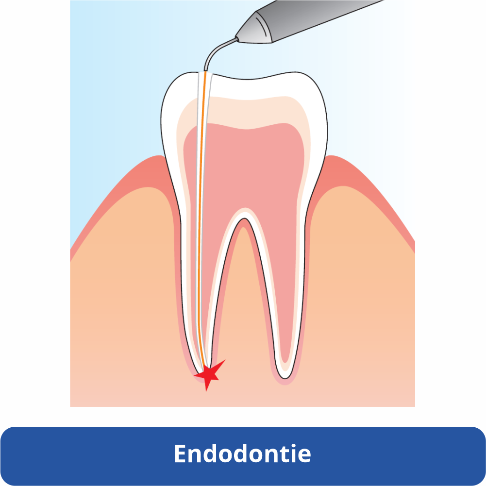 halmadent elexxion endodontie laser