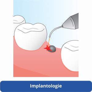 halmadent elexxion implantologie laser